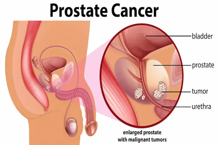 رشد سرطان پروستات در فرد میانسال 54745645640