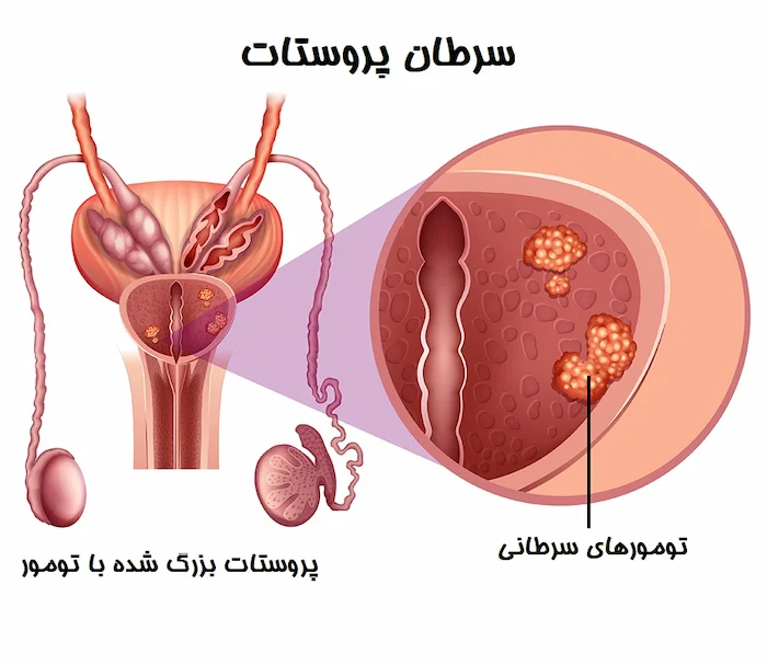 پروستات دارای سرطان در فر میانسال 65455612