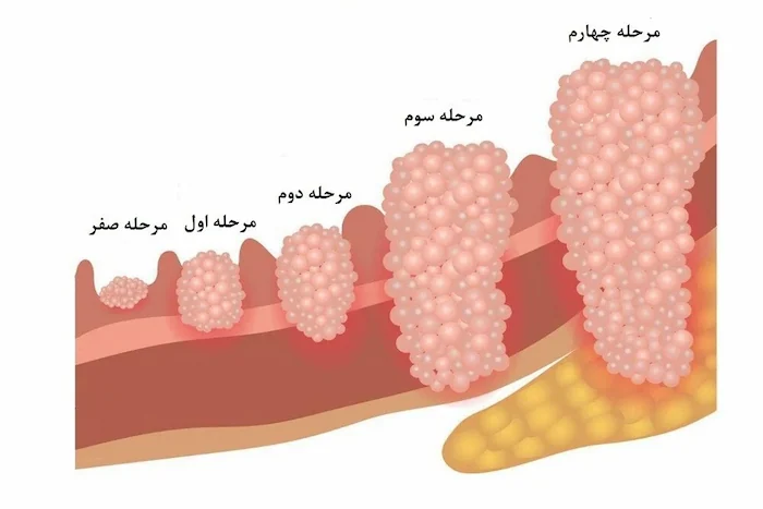 مراحل رشد و پیشرفت سرطان روده در 4 مرحله 654546541560