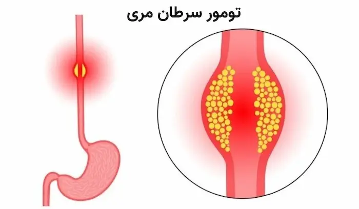 متورم شدن ریه و رشد سلول های سرطانی 2365464132