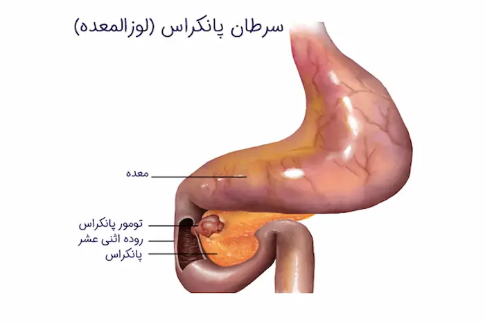 تورم توده پانکراس در بدن 145645132