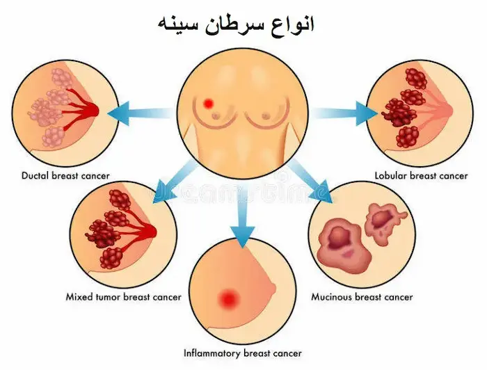 انواع سرطان سینه 544545646581200