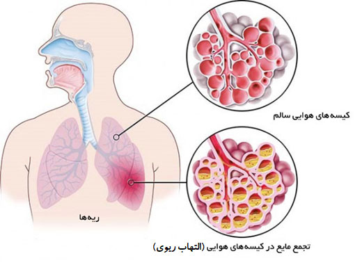 عوارض پیوند مغز استخوان 676
