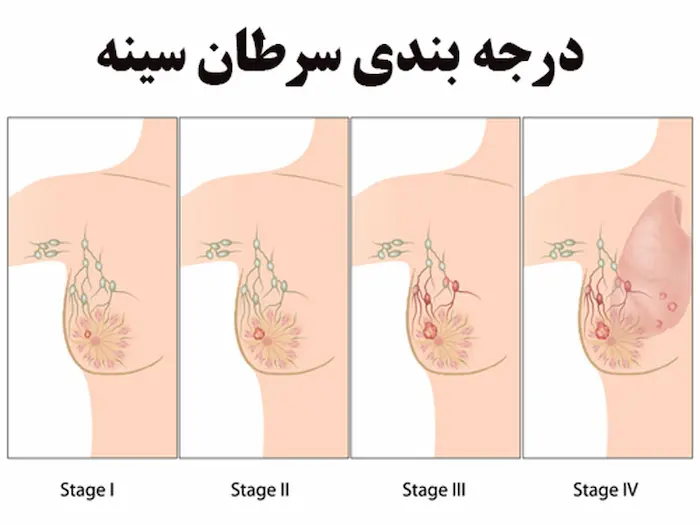 درجه بندی سرطان سینه بر اساس گرید 256564510