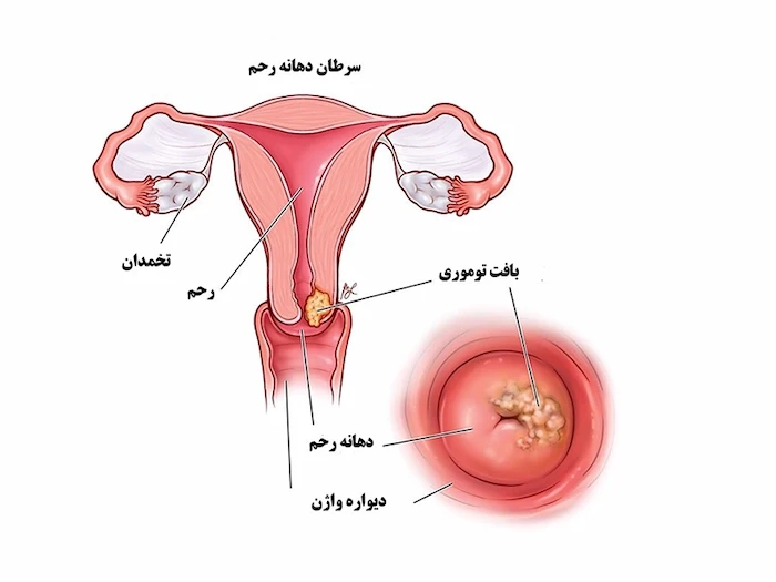 توده سرطانی رحم 564654310