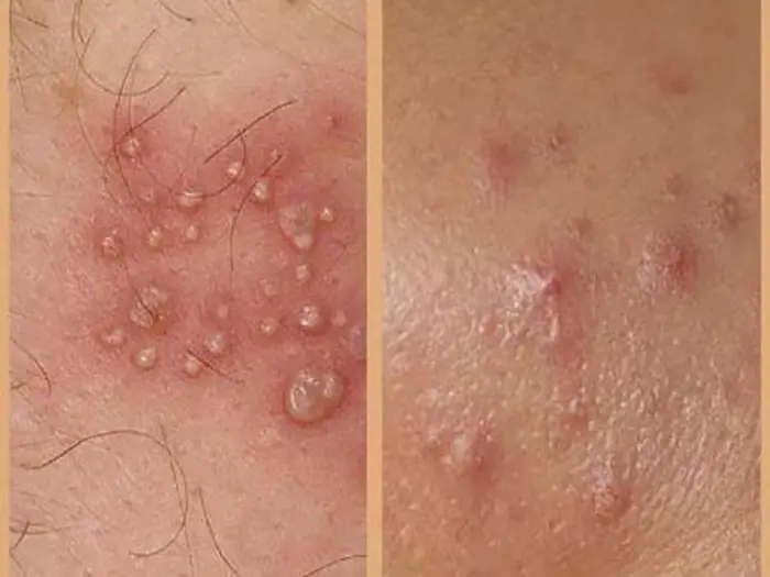 علائم ویروس اچ پی وی 435634534