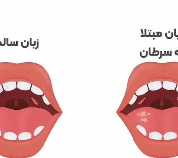 علائم سرطان زبان 656454543