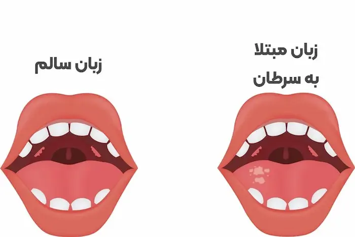 علائم سرطان زبان 656454543