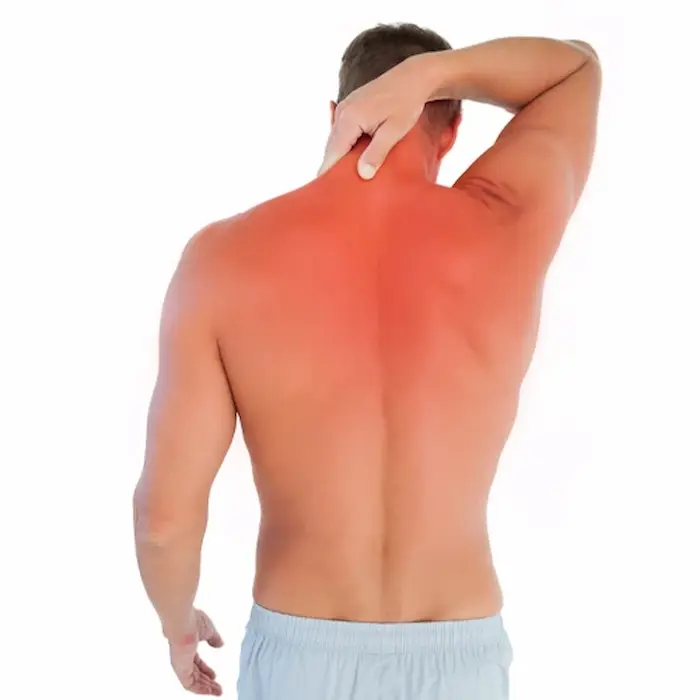 سوختگی روی بدن ناشی از پرتودرمانی و درمان با درماتیت پرتویی 5434534543