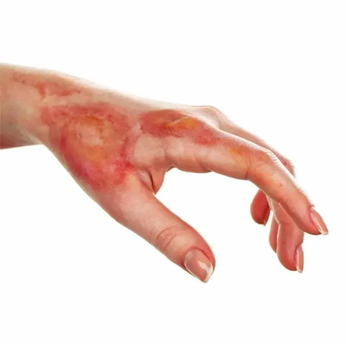 درمان با درماتیت پرتویی 654654654