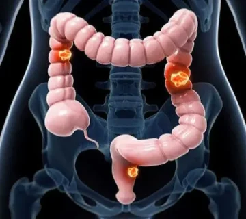 علائم ونشانه های سرطان روده بزرگ 98765343