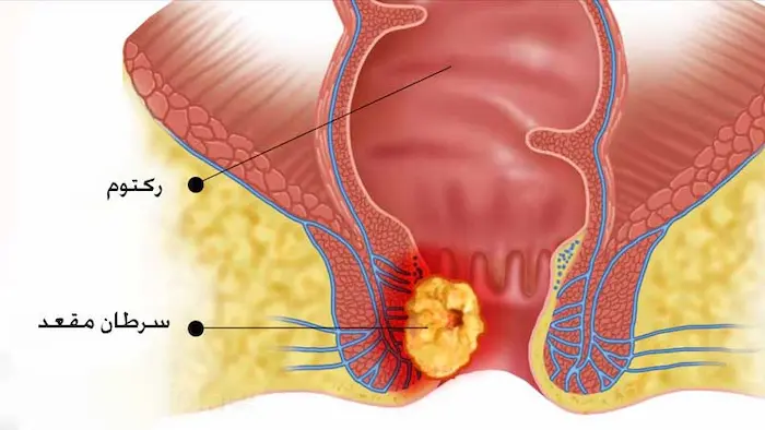 نشانه های سرطان مقعد 876543