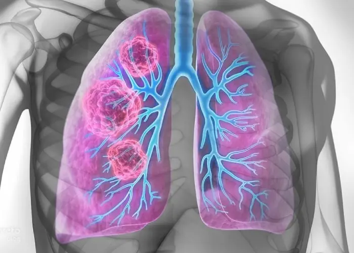 متاستاز سرطان ریه در خانم ها 898765434