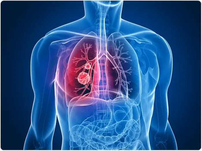 آزمایش های سرطان ریه 7666644