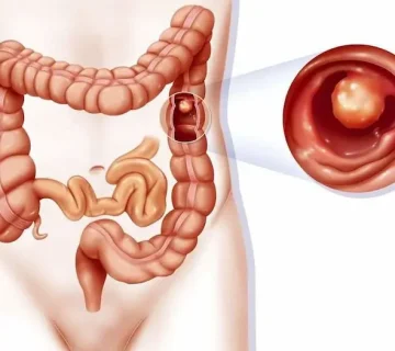 راه های تشخیص پولیپ روده 7856756