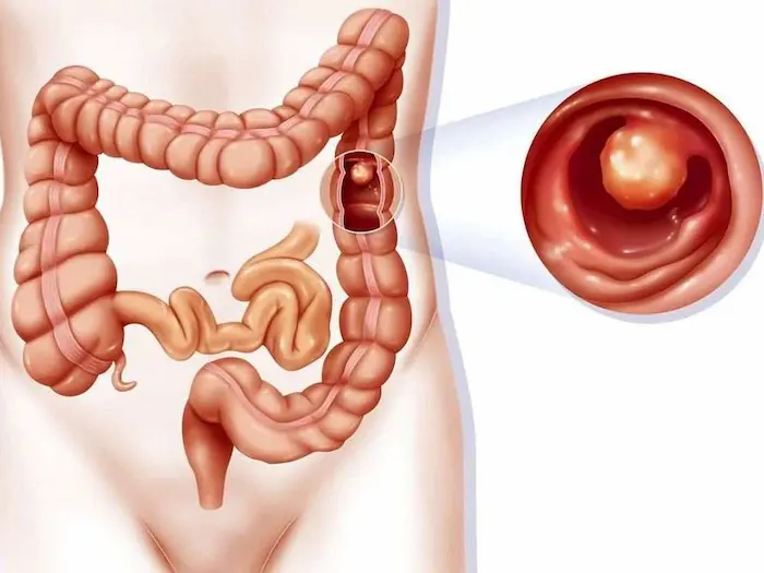 راه های تشخیص پولیپ روده 7856756