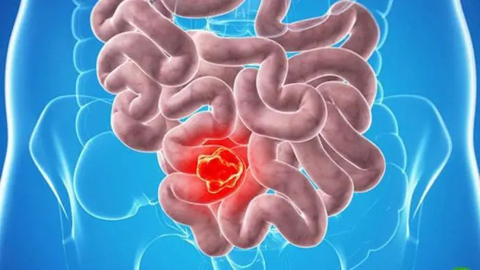 پولیپ روده و سرطان 64565
