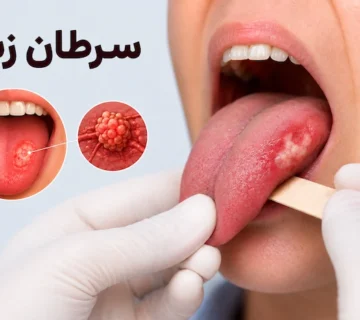 عکس سرطان زبان