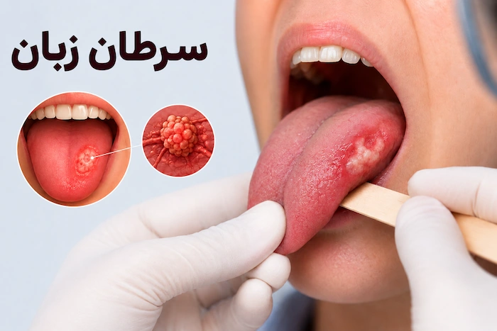 عکس سرطان زبان