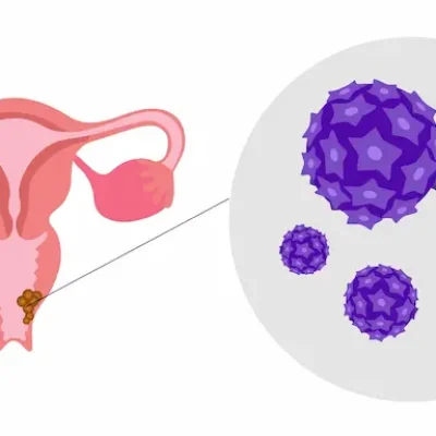 انتقال ویروس اچ پی وی به سرطان دهانه رحم 454353453