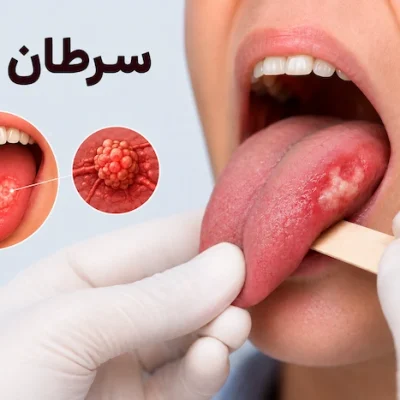عکس سرطان زبان