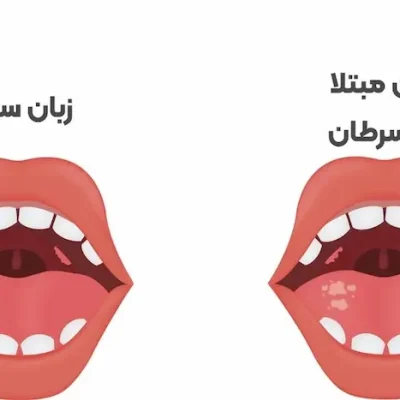 علائم سرطان زبان 656454543