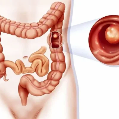 راه های تشخیص پولیپ روده 7856756